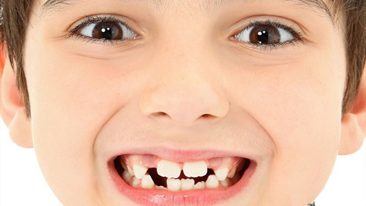 You are currently viewing Nằm mơ thấy rụng răng thì có bị làm sao hay không ?